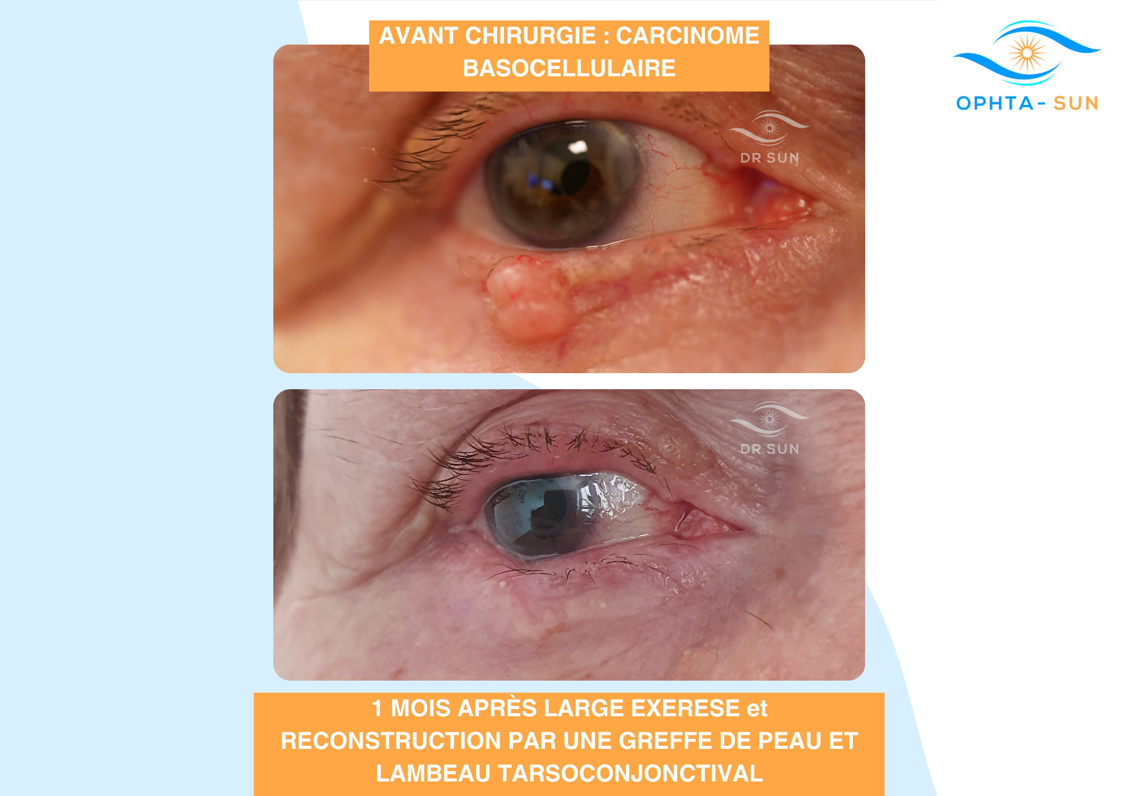 Carcinome basocellulaire avant après