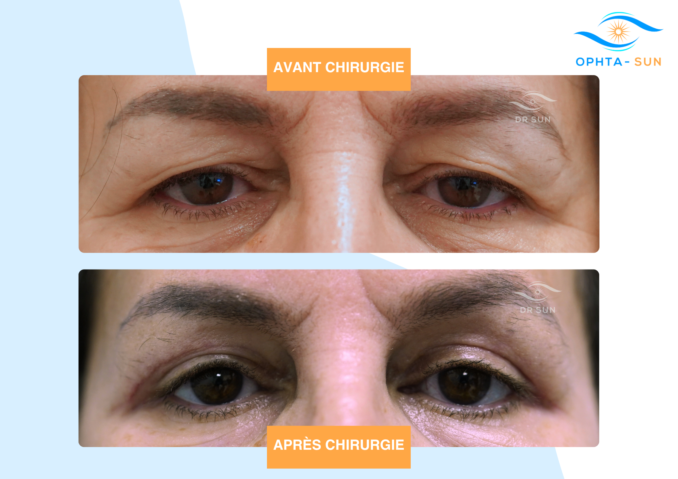 Ptosis maghreben avant après